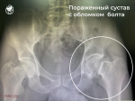 Травматологи Выборгской больницы провели успешную операцию по эндопротезированию тазобедренного сустава пациенту из Енакиево