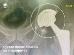 Травматологи Выборгской больницы провели успешную операцию по эндопротезированию тазобедренного сустава пациенту из Енакиево